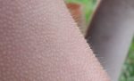 Horripilation ou « chair de poule »